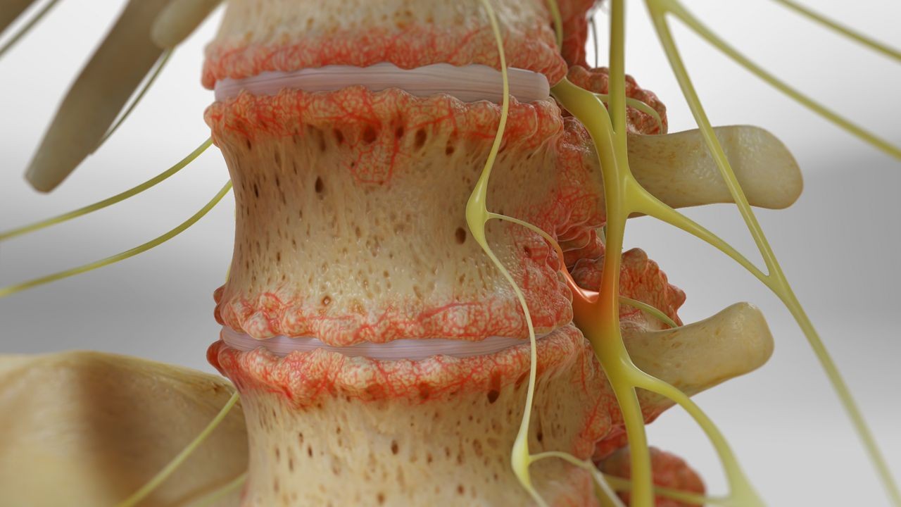 Lumbar Spondylosis Treatment