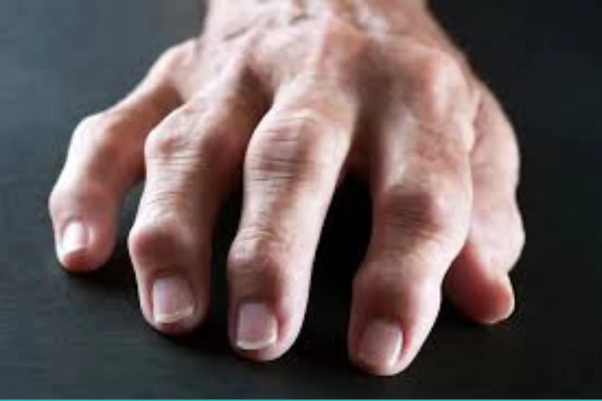 Rheumatoid Arthritis Care and Treatment in Sharjah