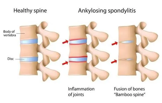 Ankylosing Spondylitis Treatment In Sharjah